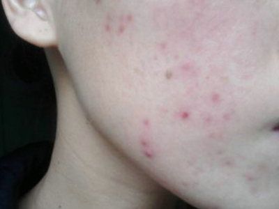 早睡对痘印淡化有用吗,早睡多久皮肤才变好