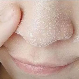 鼻子上的黑头怎么去除，为什么不建议去黑头