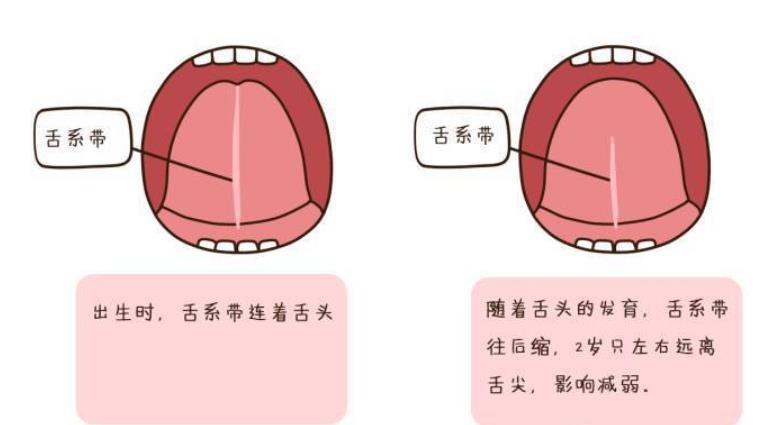 舌系带正常和不正常对照图
