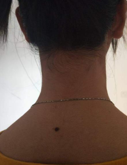 女人背部痣详图