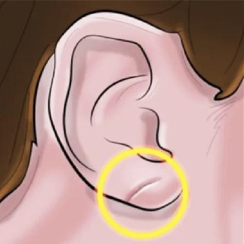 耳垂有褶皱有一条横纹,耳垂痣代表什么