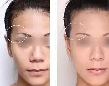 面相夫妻宫凹陷图片