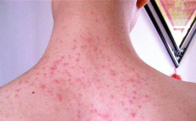 床上皮肤有螨虫的症状图