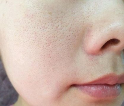 毛孔粗大怎样缩小毛孔，皮肤粗糙暗沉毛孔粗大怎么改善