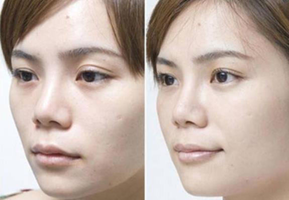 苹果肌和法令纹对比图,苹果肌下垂前后对照图