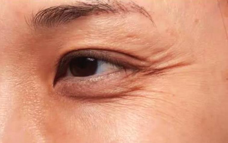 眼部衰老变化图