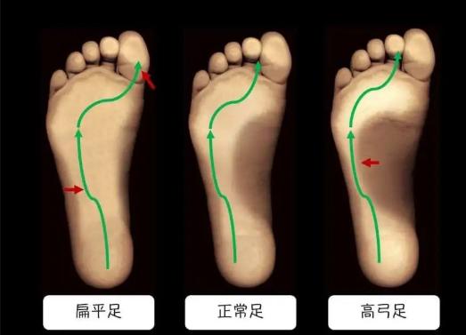 足弓高低判断图图片