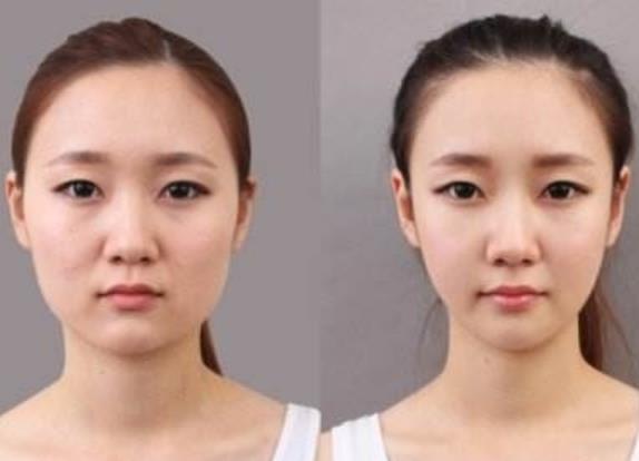 拔智齿前后脸型对比图片