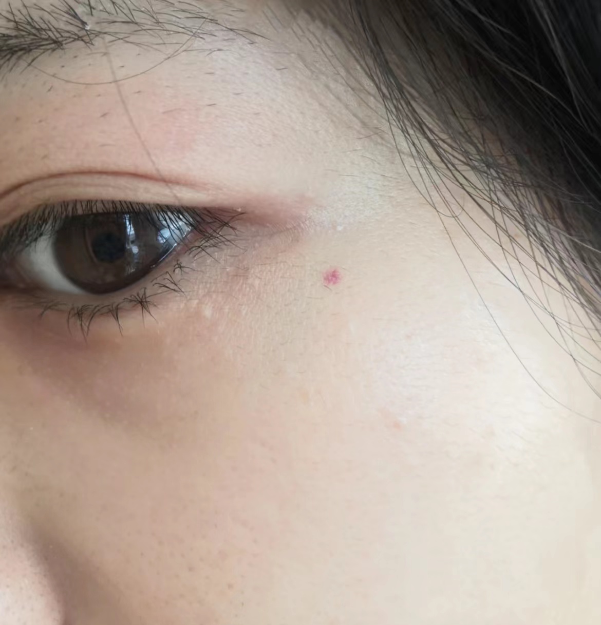 朱砂痣真实长相图片,脸上朱砂痣真实图片