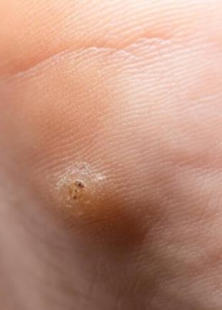 瘊子的形状和图片,瘊子图片真实照片