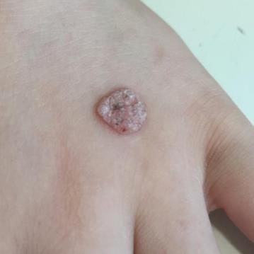 瘊子的形状和图片,瘊子图片真实照片