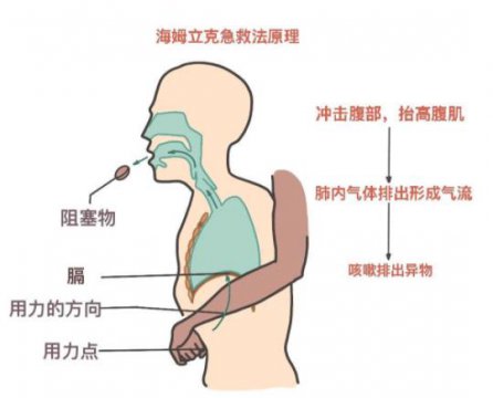 正确的海姆立克法图片