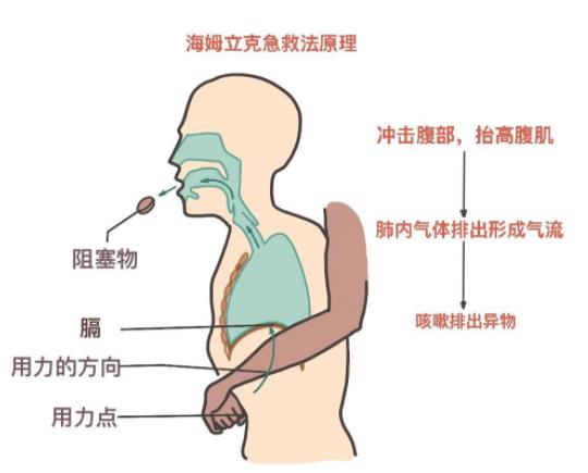 正确的海姆立克法图片