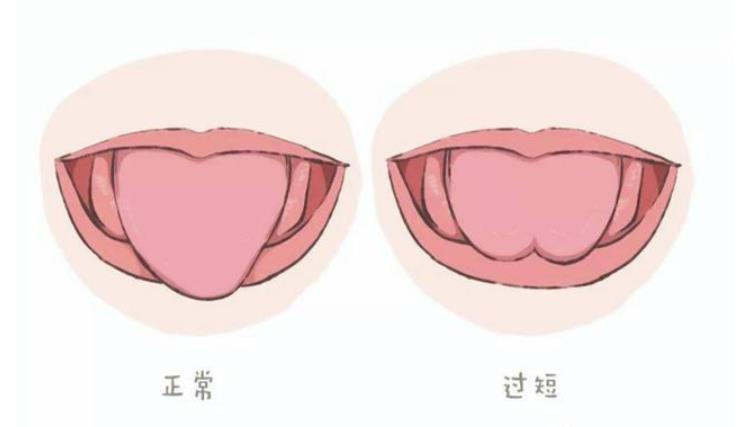舌系带正常和不正常对照图