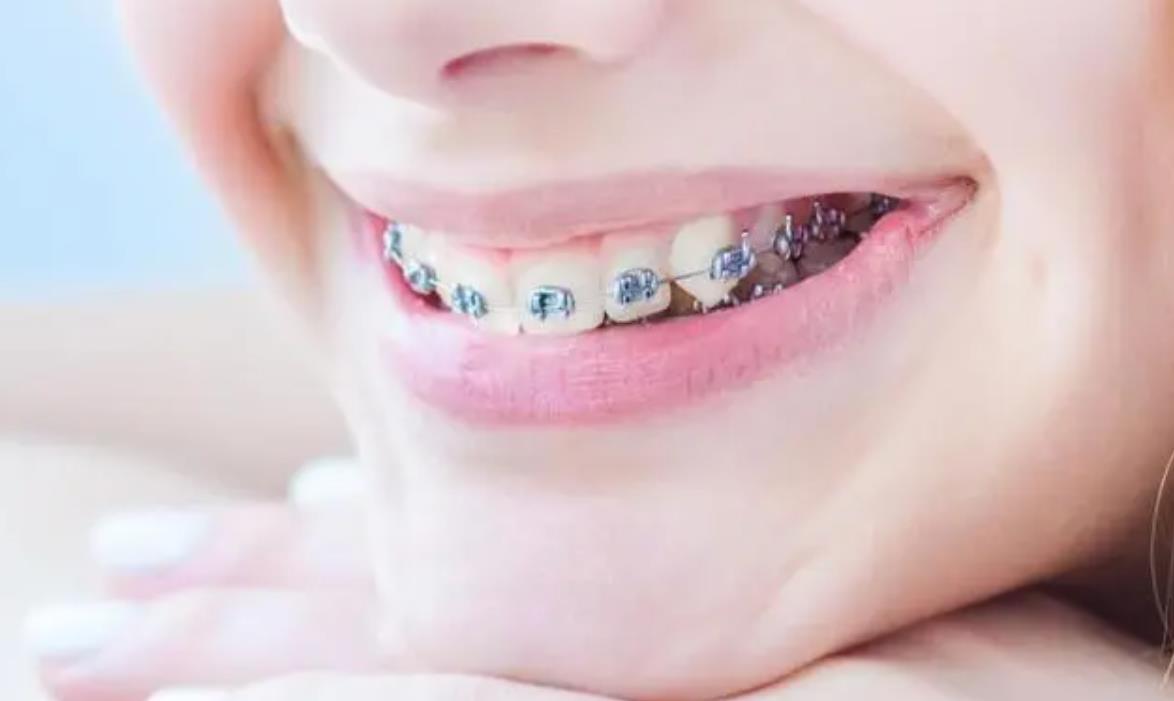 30岁为什么不建议箍牙