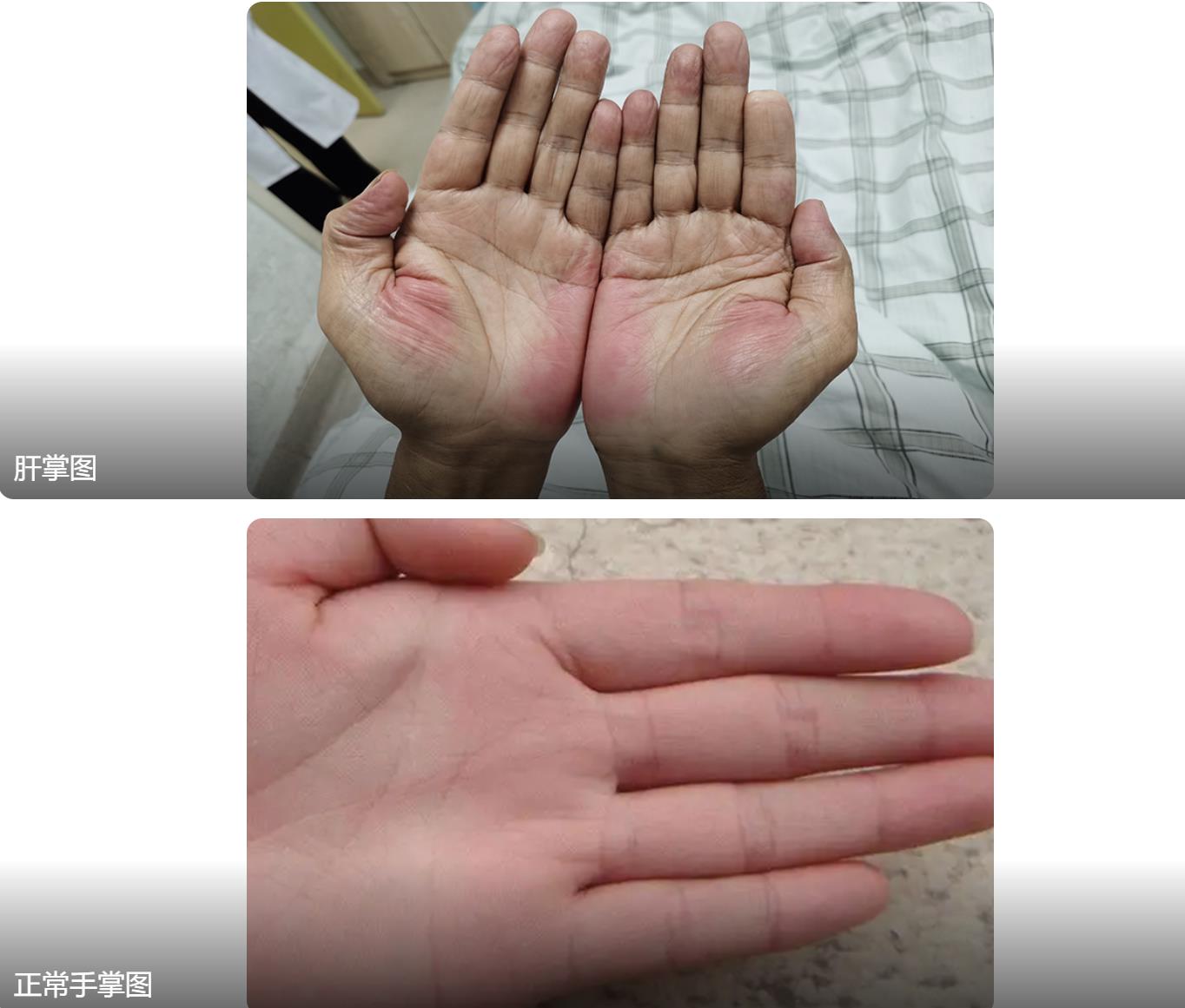 肝掌和正常手掌比较图