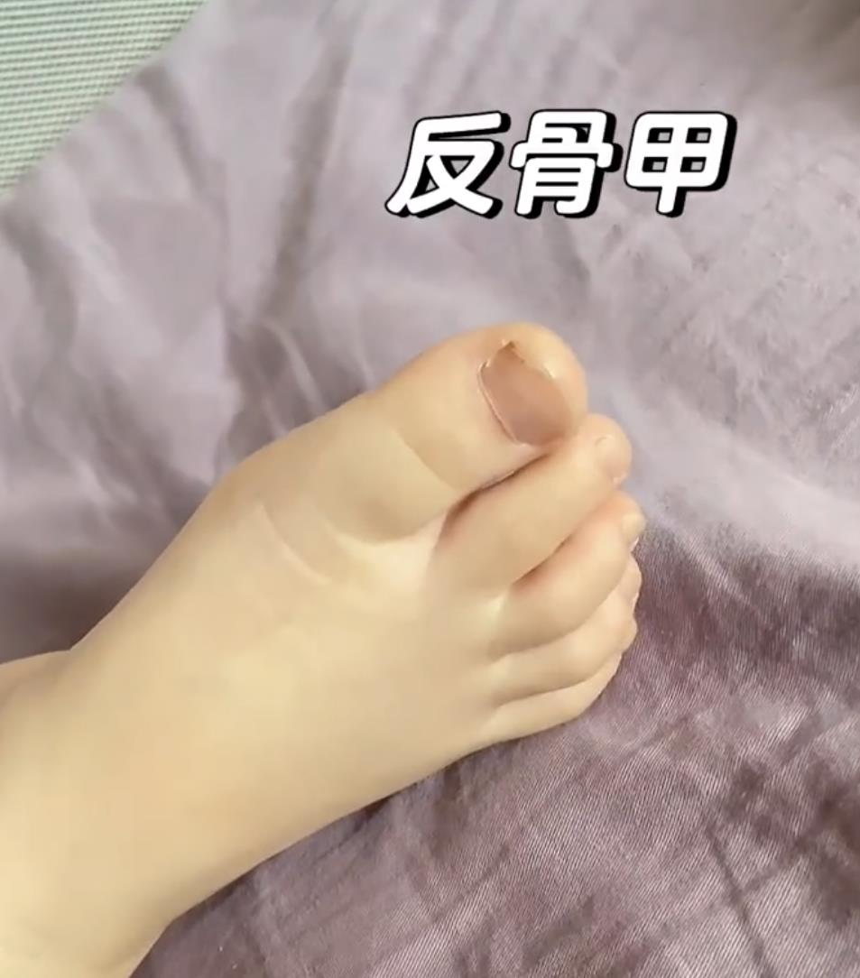反骨甲和正常甲对比图