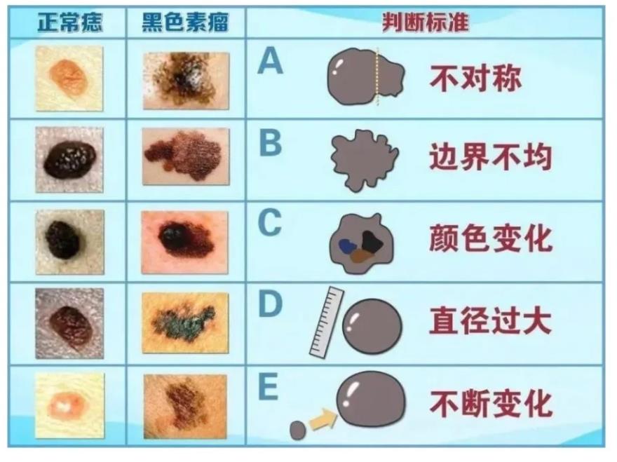 正常痣和黑色素痣图片