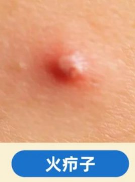 火疖子是什么样子的图片