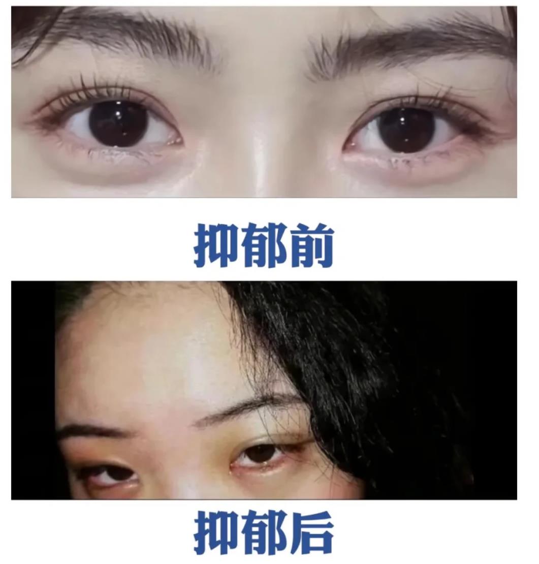 抑郁症面部特征照片