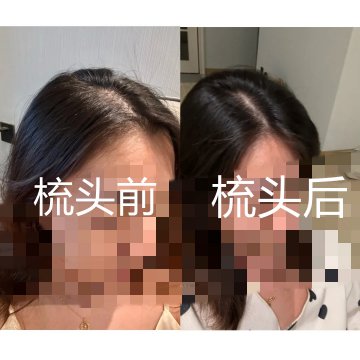坚持梳头一年后的变化