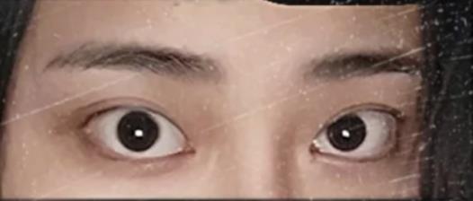什么是四白眼