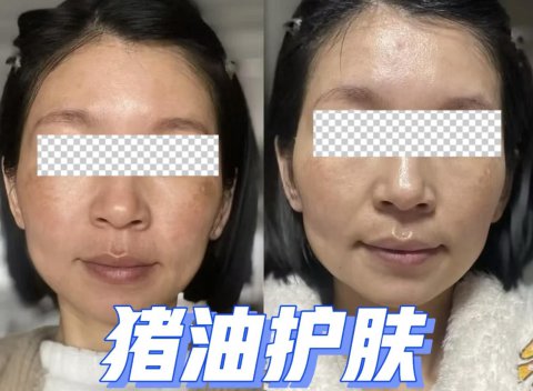 猪油擦脸一年后的效果