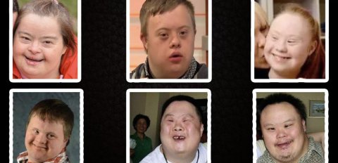 唐氏儿的样貌图片