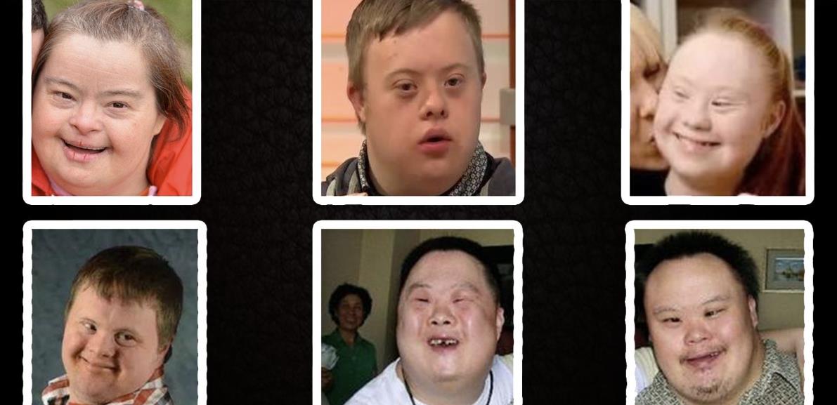 唐氏儿的样貌图片