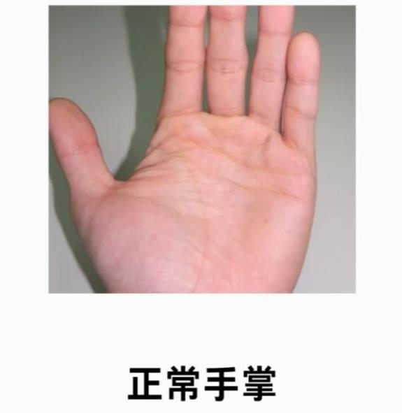 正常手掌颜色照片,正常人的手掌是什么颜色