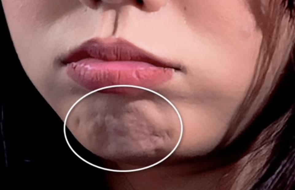 下巴核桃纹是什么原因,下巴核桃纹代表什么